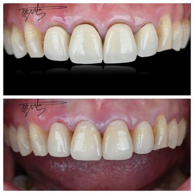 comprare Confortevoli ponti dentali in zirconia Trasformazioni di colore naturale leggere per un'esperienza ottimale del paziente fabbricazione online