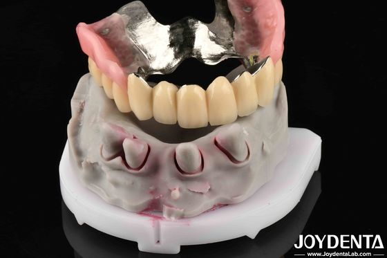 comprare Materiale metallico dentale avanzato per sostenere le esigenze di masticazione fabbricazione online