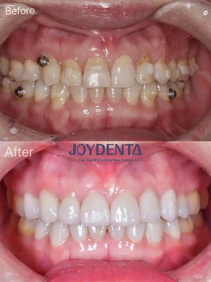 comprare Finestre dentali per denti mancanti. fabbricazione online