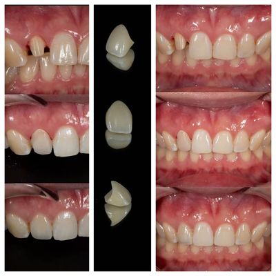 comprare Laboratorio di Fabbricazione Corone Dentali in Zirconia | Outsourcing Corone di Precisione - Joydentalab fabbricazione online
