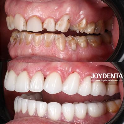 comprare Soluzioni Premium per Corone Dentali in Zirconia | JOY Dental Lab fabbricazione online