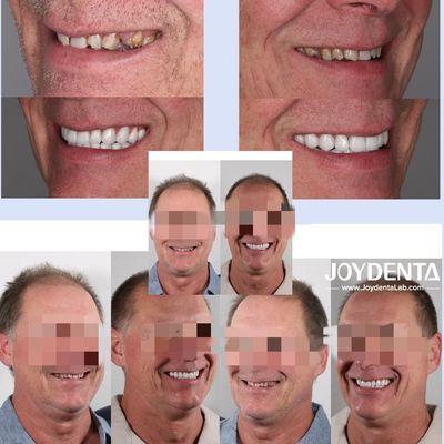 comprare Dentiere in zirconia che imitano i denti naturali fabbricazione online