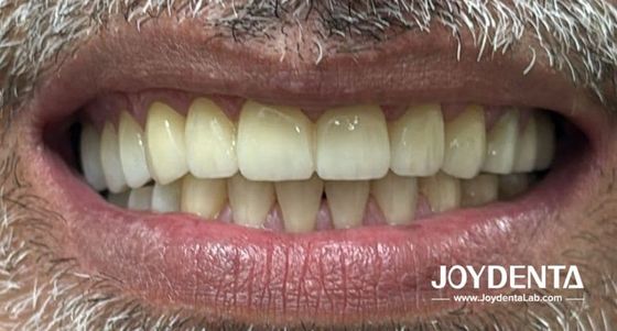 comprare Dentiere in zirconia che imitano i denti naturali fabbricazione online