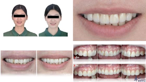 comprare Prodotti popolari di Joydentalab: finiture estetiche simulate fabbricazione online