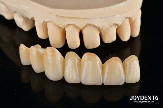 comprare Unveil True Biomimicry: Introducing Our Multi-Layered Zirconia Aesthetic Bridge fabbricazione online