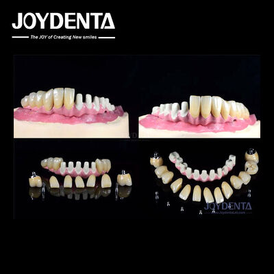 comprare Impianti dentali endossei multipli connessione interna per il ripristino dell' arco completo fabbricazione online