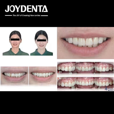 comprare Prodotti popolari di Joydentalab: finiture estetiche simulate fabbricazione online