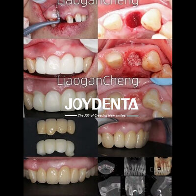 comprare Zirconia Dentale Sicura con Tecnologia a Gradiente Multistrato fabbricazione online