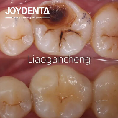 comprare Intaglio dentale di porcellana per adulti e bambini prestazioni eccezionali fabbricazione online