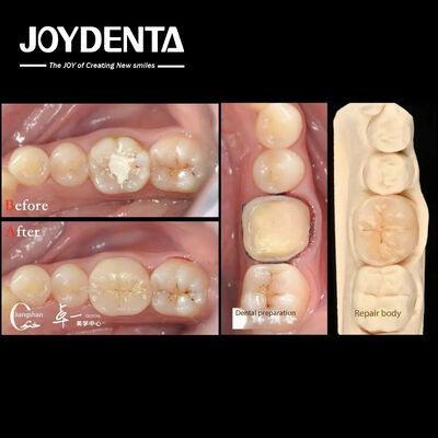 comprare Biocompatibilità e alta compatibilità con il restauro dei denti naturali fabbricazione online