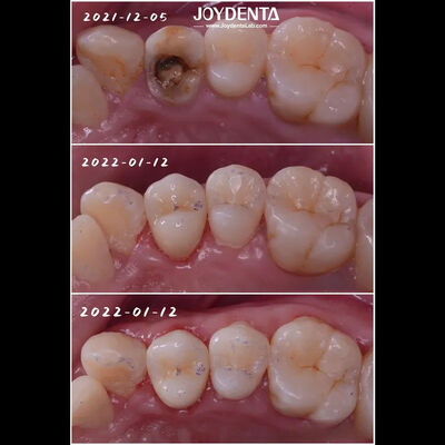 comprare Infissi di porcellana dentale adatta per restaurare i denti danneggiati per adulti e bambini fabbricazione online