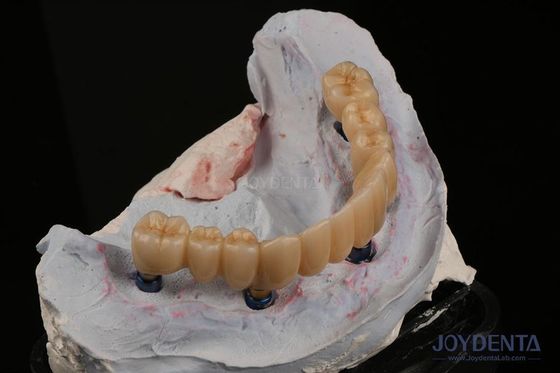 Restaurazione dentale Implantazione di denti multipli Endosseo Sostituzione di due denti anteriori