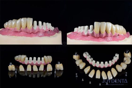 Impianti dentali endossei multipli connessione interna per il ripristino dell' arco completo