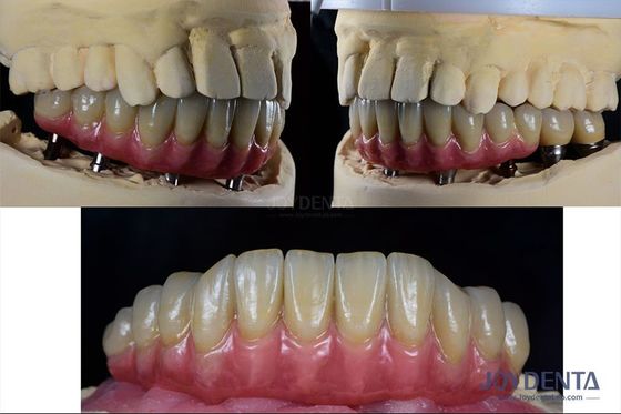 Ricostruzione dentale Implantazione dentale multipla Titanio Protesi connessione interna