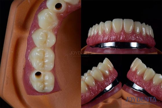 Impianti dentali multipli in titanio Impianti dentali interni resistenti alle crepe personalizzati