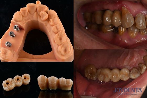Colore ultra duro Stabilità Implantazione dentale Corona OEM Facile manutenzione Durata