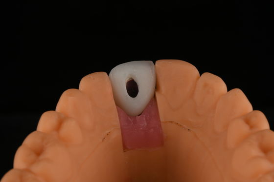 Impianti dentali in titanio a superficie rugosa Chirurgia per la sostituzione dei denti anteriori