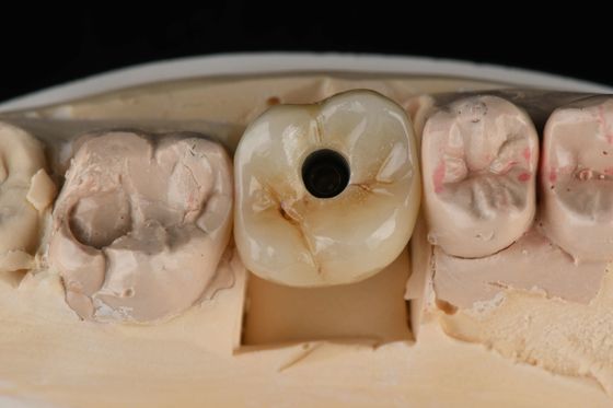 Titanio 10mm Impianti dentali a dente singolo Sostituzione di abuto Autopuntamento sabbiato