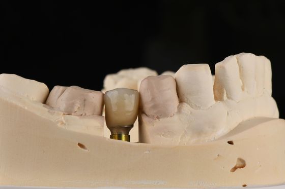Impianto dentale singolo sabbiato con filo di auto-toccaggio e connessione interna esessuale