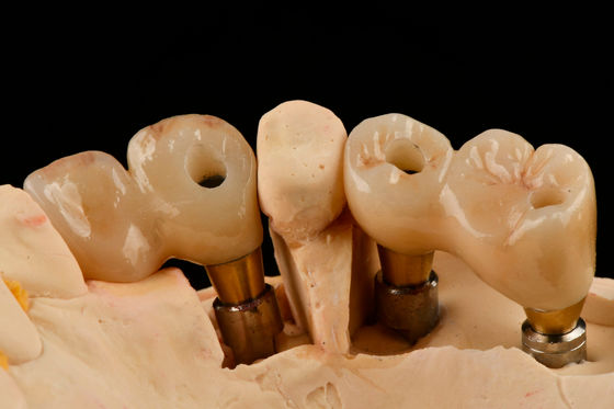 Impianto dentale in titanio a filo di 3,0 mm auto-toccante funzionalità ottimizzata