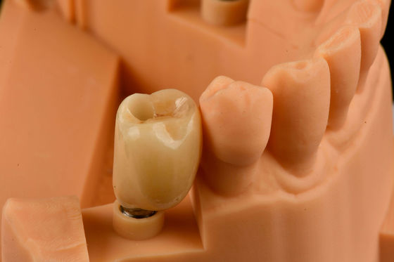 Impianti dentali in titanio a sabbiatura con connessione esessuale interna Sostituzione dentale singola