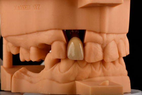 Ricambio di impianto dentale di titanio singolo