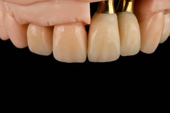 Impianto di sostituzione dentale singolo sabbiato in titanio con sterilizzazione con irradiazione gamma