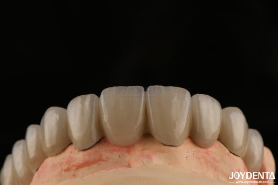 Porcellana PFM fusa a corone e ponti metallici Legatura senza saldature per sorrisi naturali