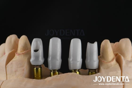 Implantazione dentale su misura Abutment in zirconia per restauri di unità singola o multipla