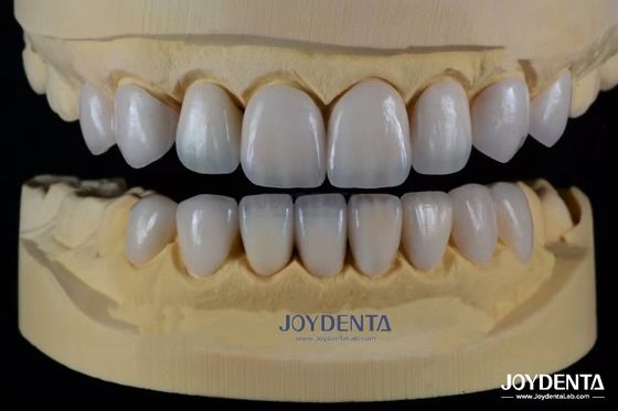 Finiture di porcellana in ceramica avanzata, biocompatibile, abbinata a un sorriso naturale