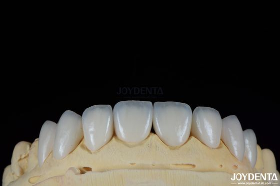 Finestre dentali resistenti alle macchie e durevoli con sfumature personalizzate per i denti naturali