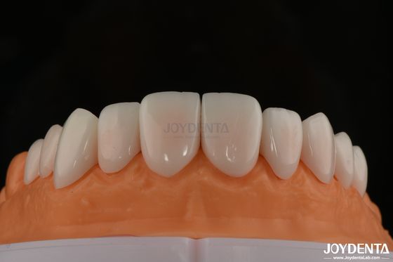 Conforto ottimale per il paziente con finiture di porcellana biocompatibili e delicate sui tessuti orali