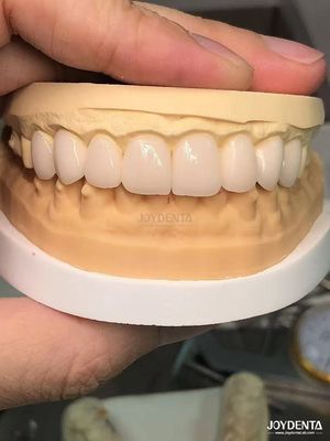 Sfumature personalizzate per abbinare i denti naturali Biocompatibili e resistenti alle macchie Finiture dentali