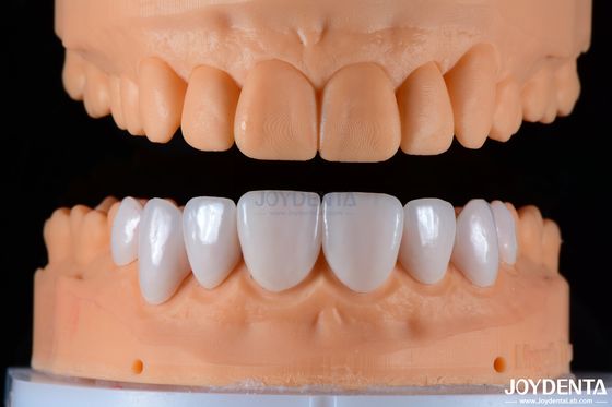 Protezione della protezione da attacchi di porcellana Ceramica e estetica naturale con forte aderenza