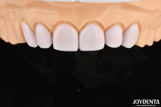 Carpetti dentali per denti disallineati Biocompatibilità e delicatezza sui tessuti orali
