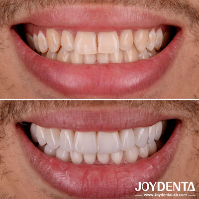 Perfetto allineamento di porcellana finiture per denti trasparenza naturale finiture dentali laminate