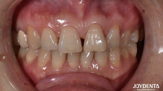 0Spessore di.5 mm Finiture dentali in ceramica Naturale in cerca di denti anteriori Indicazione