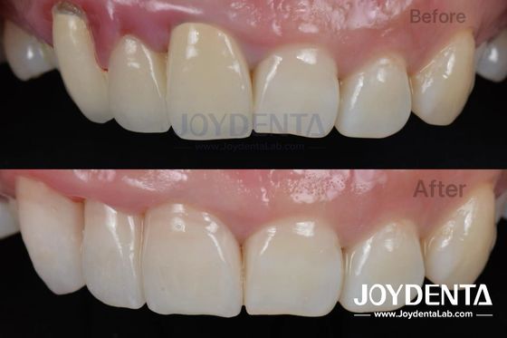Procedura indolore BOPT Tecnica dentale per una precisa preparazione dei denti