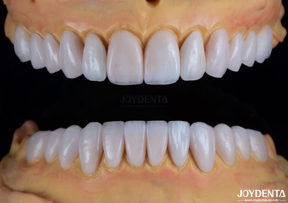 Finestre di porcellana Emax realizzate su misura Restorazioni dentali di consistenza liscia