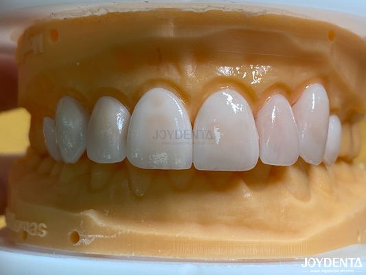 Alte permeabilità rivestimenti di aspetto naturale rivestimenti di porcellana Emax personalizzati