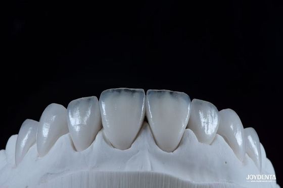 Naturale Emax Veneer di porcellana comodo Fit Ultra sottile Emax Veneer