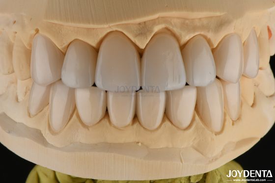 0.3-0.5mm di spessore Feldspathic Porcellana Veneer Alta resistenza alle fratture Aggiornare il tuo sorriso