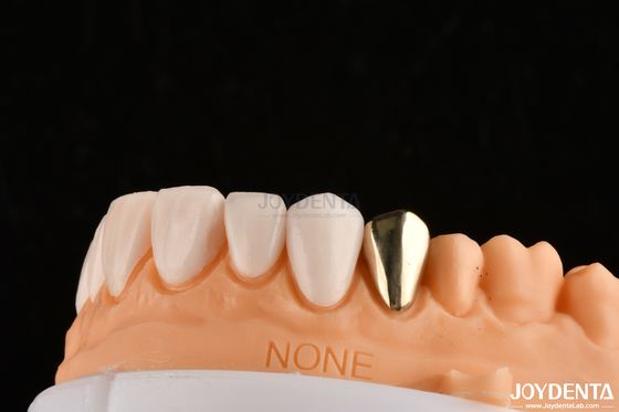 IPS ultra sottile Emax Pressa Veneers Veneers cosmetici dentali per restauri anteriori posteriori