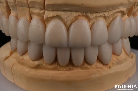 0.3mm Spessore Ips Emax Finiture Ceramiche Finiture Anteriori Posteriori Restaurazioni