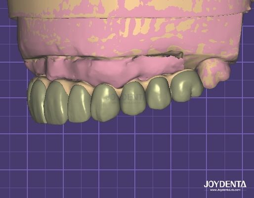 Sicurezza dei dati conforme all'HIPAA Modello 3D di ceretta digitale per le modifiche dentali