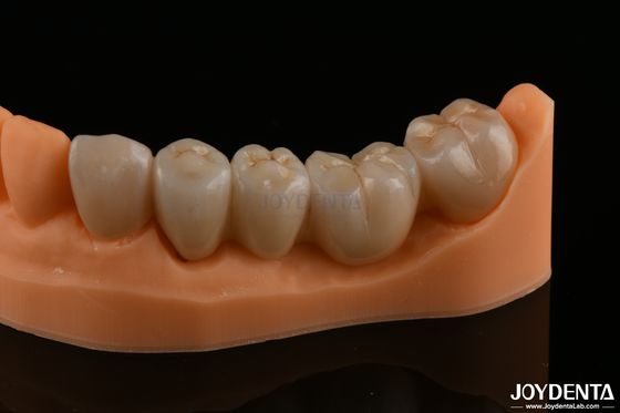 Restaurazioni dentali di precisione Zirconia completa Alta resistenza flessibile Colore naturale