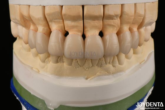 Corone in zirconia a strati di alta traslucidità ponti restauri dentali aspetto realistico