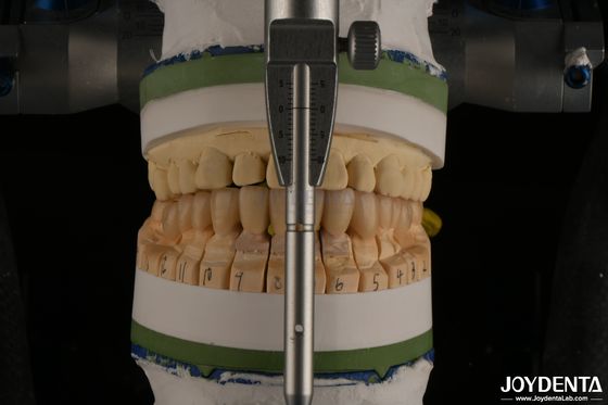 Circonia dentale a strati di porcellana per la restaurazione degli impianti