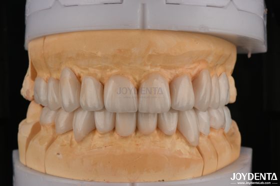 Circonia stratificata ad alta traslucidità per restauri dentali a contorno completo