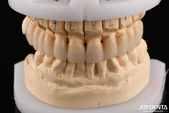 Superficie lucidata Resistenza flessibile Zirconia stratificata per ponti 6.0-6.1 G/cm3 Densità